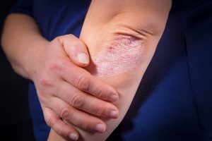 Dealing with Eczema? Dupixent May Be the Solution You’ve Been Searching For 