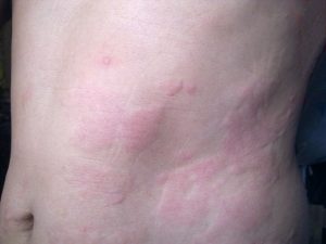 Hives May Be Common but That Doesn’t Mean You Don’t Need Specialized Help
