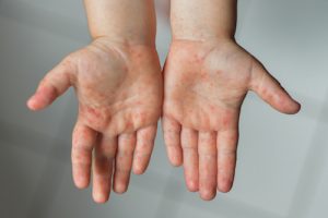 Do You Have Rashes and Swelling on Certain Parts of Your Body? You Could Be Dealing with Angioedema or Urticaria 