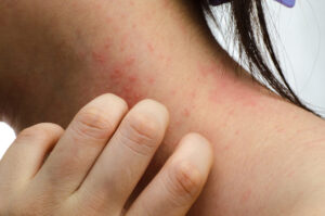 Find Answers to Your Common Questions About Contact Dermatitis