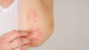 Learn How Treatment with Dupixent Could Be Just What Your Eczema Needs