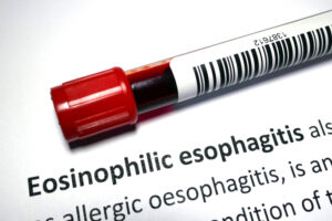 Learn How We Can Diagnose and Treat Eosinophilic Esophagitis
