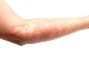 Are You Suffering from a Hives Breakout? Learn Some Simple Ways You Can Treat Them 