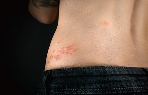Is It Safe To Treat My Skin Rash In California with Over-The-Counter Medication?