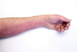 6 Different Ways to Treat Hives