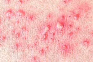 If You’ve Had Hives for More Than 24 Hours Then it’s Time to Get Relief