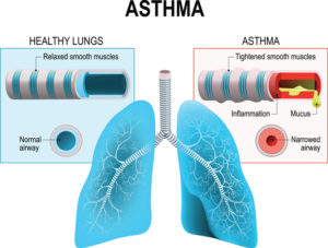 Is CINQAIR the Answer You’ve Been Looking for to Handle Your Sudden Asthma Attacks
