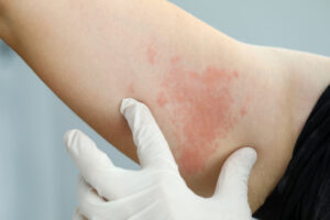 Read Answers to Common Questions About Xolair Injections and How They Can Help Allergic Asthma and More