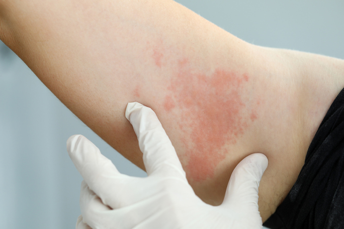 allergic reaction to b12 injection Hives from liquid? : r/B12_Deficiency Common & Rare Side Effects